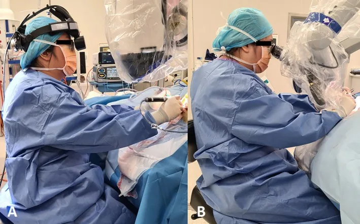 Tư thế phẫu thuật viên trong mổ tai: (A) dùng exoscope 3D đeo đầu RoboticScope; (B) dùng kính hiển vi Zeiss OPMI Sensera. Ảnh: Ajmera A. và cộng sự, ANZ J Surg 2025 (doi:10.1111/ans.70278), CC BY 4.0